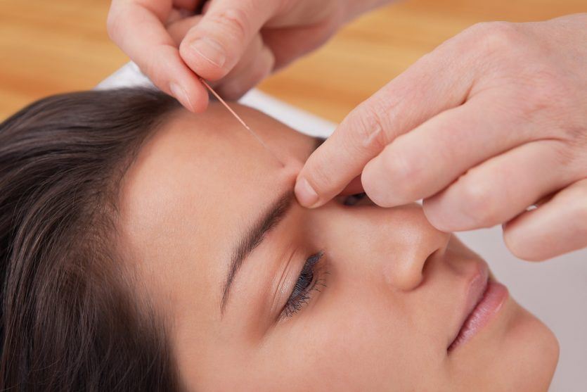 针灸针在一个年轻女子的头上的spa tcm